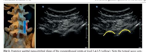 figure   ultrasound guided injections   lumbar spine semantic scholar