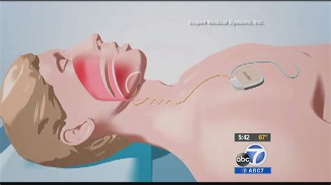 inspire upper airway stimulation helps   sleep apnea abc