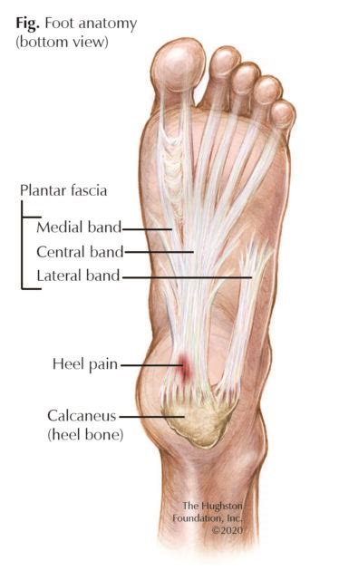 Plantar Fasciitis A Painful Heel Hughston Clinic