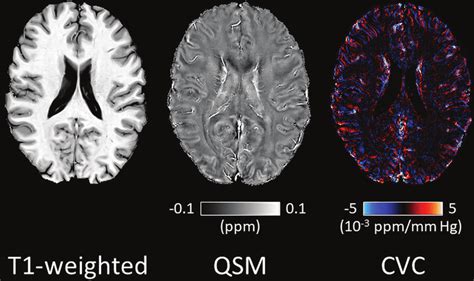 representative  weighted image quantitative susceptibility map   scientific