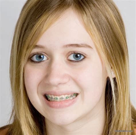 60 Photos Of Teenagers With Braces Oral Answers