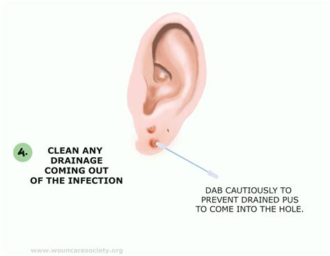 drain infected ear piercing wound care society