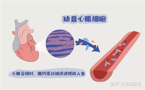 冠心病是怎么诊断的？ 知乎