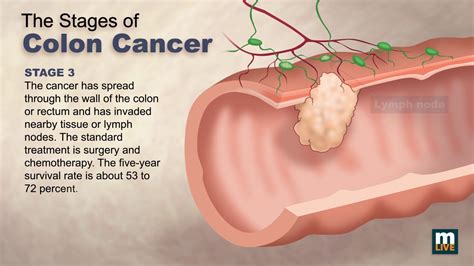 Stage 2 Or 3 Colon Cancer Cancerwalls