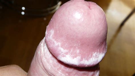 smegma foreskin tumblr