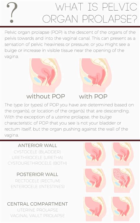 Pelvic Organ Prolapse What It Is And How To Manage It Pelvic Organ My