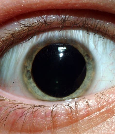 What Does It Mean To Have Large Pupils With Drug Use Quora