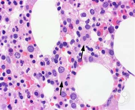 myeloid neoplasms myelodysplastic syndrome refractory ctyopenia with