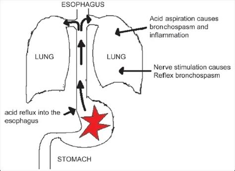The Gastric Acid Reflux Into The Esophagus And Trachea Open I