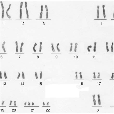 G Banded Karyotype Of The Mother Revealing Trisomy 21 47 Xx 21