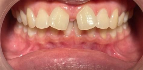 gigi renggang diastema definisi penyebab jenis  mengatasinya