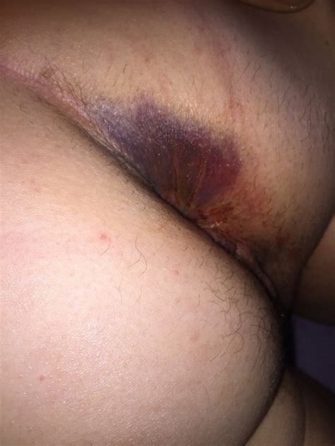 Bruised Ass Arse After Anal Fisting Ouch 11 Pics