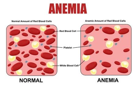 anemia plant based pharmacist