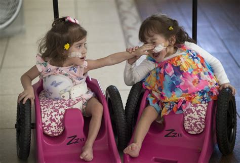 California Conjoined Twins 2 Who Were Separated Thrive