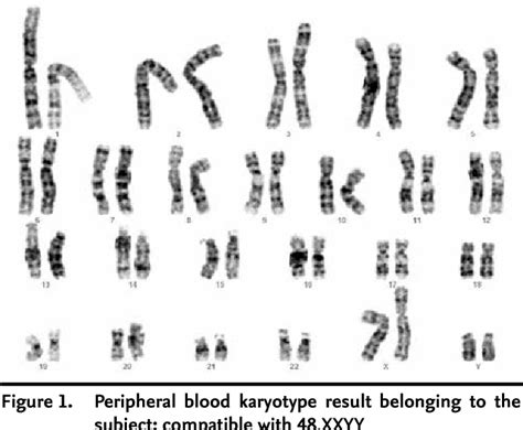 Figure 2 From A Rare Sex Chromosome Aneuploidy 48 Xxyy