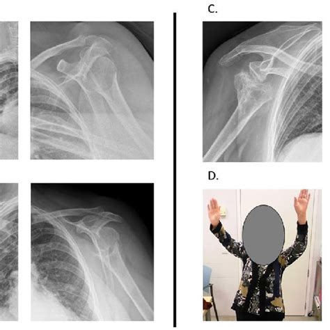 neer s classification of proximal humeral fractures modified from neer