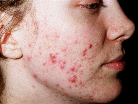 Acne Vulgaris Mobile Physiotherapy Clinic Ahmedabad Gujarat