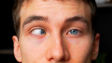 cross eyed   strabismus types  treatments eye doctor explains youtube