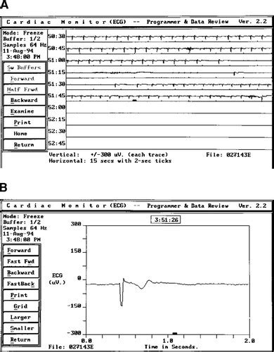 The Etiology Of Syncope In Patients With Negative Tilt Table And