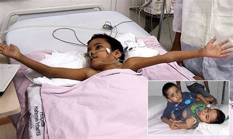 conjoined twin survives separation operation which killed brother in brazil daily mail online