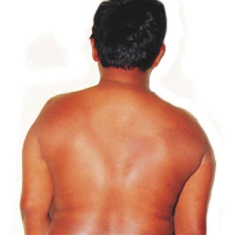 A Patient With Klinefelter Syndrome Showing Narrower Shoulders