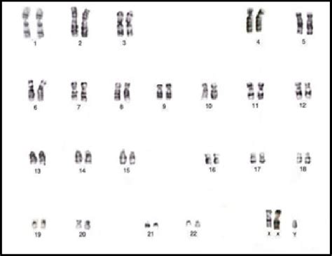 The 3 Years Old Male Patient Had An X Chromosome Duplication With