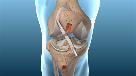 Acl Surgery New York City Knee Ligament Surgery Nyc Acl