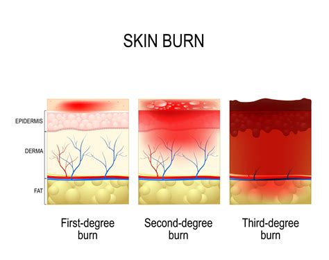 critical steps  burn treatment  burns occur