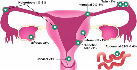 uncommon implantation sites of ectopic pregnancy thinking beyond the