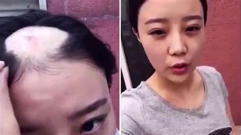 corn drill challenge woman left with massive bald patch hits back at
