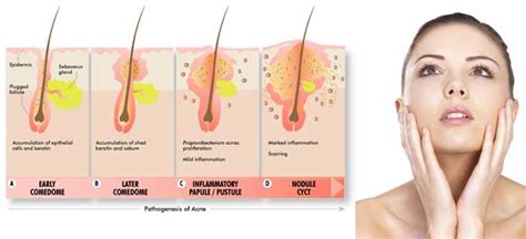 Acne Its Types And Medications Mediologiest