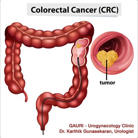 Colon Colorectal Cancer Symptoms Diagnosis Gauri Hot Sex Picture