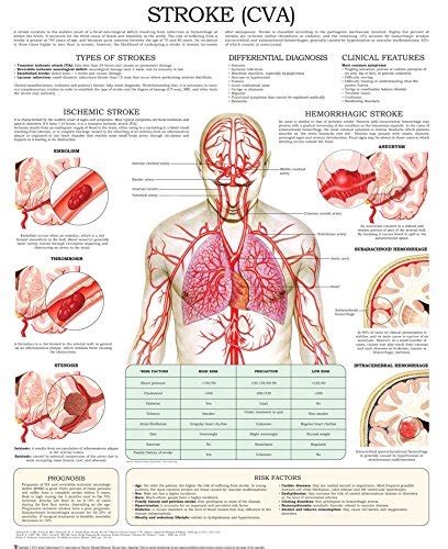 understanding stroke laminated anatomical chart  edition lupongovph