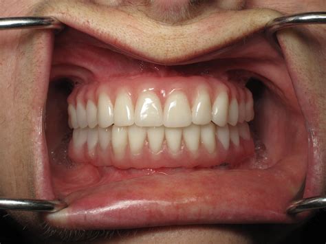 temporary full implant teeth    step