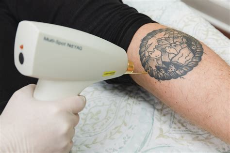 picoway laser tattoo removal  houston ovation med spa