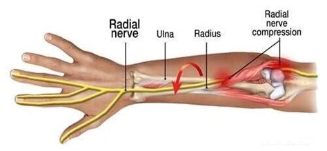 radial nerve entrapment physical therapt comprehensive athletic recovery