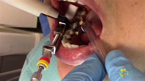 cavity filling  dental cleaning youtube