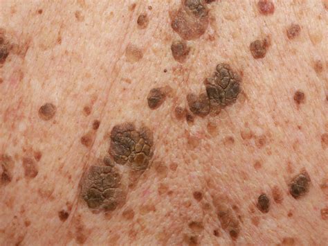 seborrheic keratosis condition treatments  pictures  adults