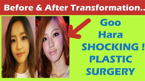 Goo Hara Plastic Surgery Before And After Full Hd Youtube