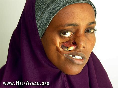 somali woman ayan mohamed waits 23 years for surgery to fix shattered