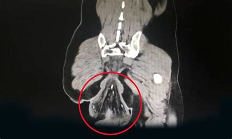 Chinese Man S Rectum Falls Out After 30 Mins On The Toilet Daily Mail