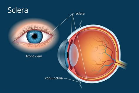 pin on glaucoma