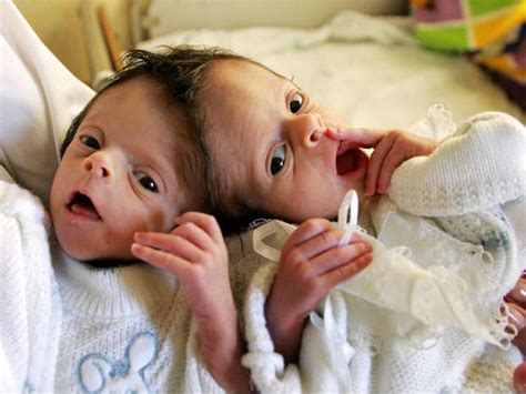 conjoined twins warning graphic images conjoined