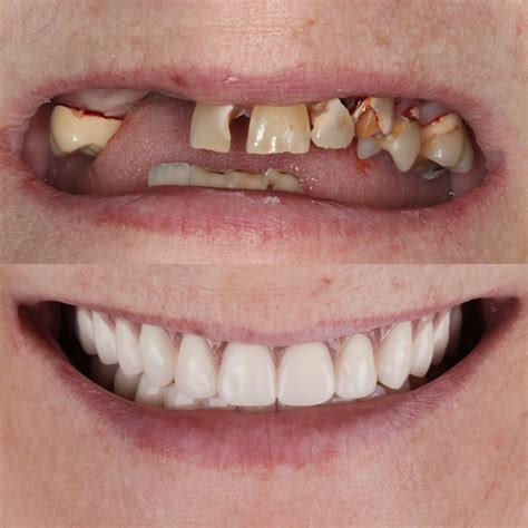 dentures  replace missing teeth knoxville family dentistry