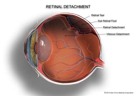 basics retinal detachment sydney ophthalmic specialists