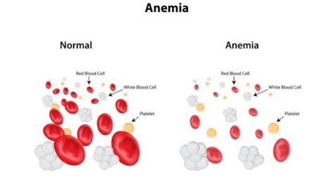 anemia and health health tips anemia and health articles and news
