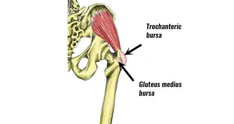 hip bursitis trochanteric bursitis symptoms  treatment