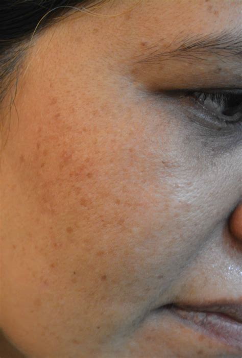 black spots laser treatment  lahore specialist laser clinic  advice