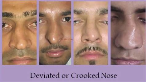 nose rhinoplasty surgery lahore pakistan  youtube