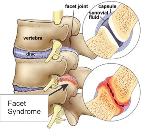 facet syndrome decompression therapy  gilbert clinic
